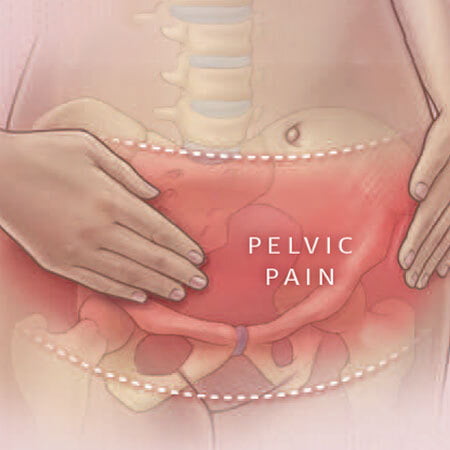 Chronic and Persistent Pelvic Pain